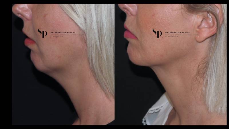 Visage - Lipoaspiration du cou
