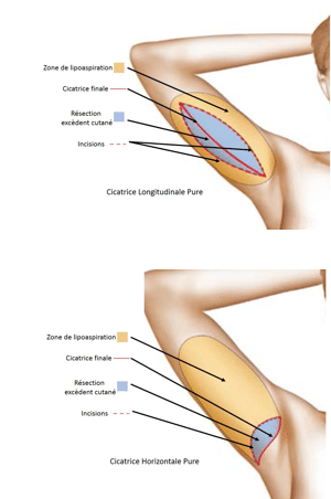 La chirurgie de l’homme Lifting de Bras ou Dermolipectomie Brachiale