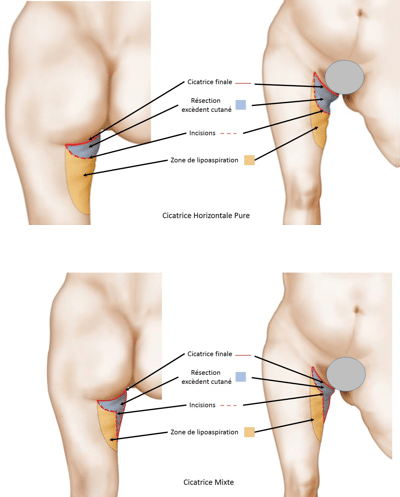 La chirurgie de l’homme Lifting de Cuisse ou Dermolipectomie Crurale
