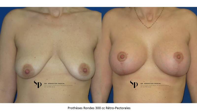 Poitrine - Cure de ptose mammaire SANS PROTHESES