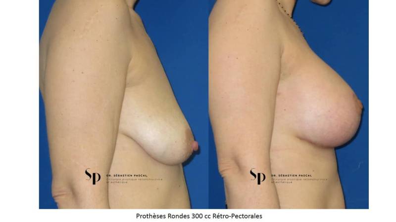 Poitrine - Cure de ptose mammaire AVEC PROTHESES (2)