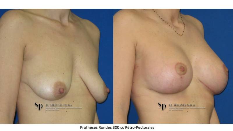 Poitrine - Cure de ptose mammaire AVEC PROTHESES (2)