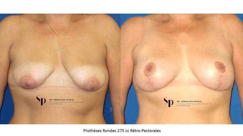 Poitrine - Cure de ptose mammaire AVEC PROTHESES (2)