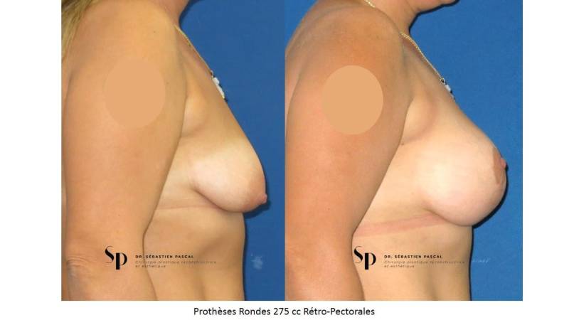 Poitrine - Cure de ptose mammaire AVEC PROTHESES (2)