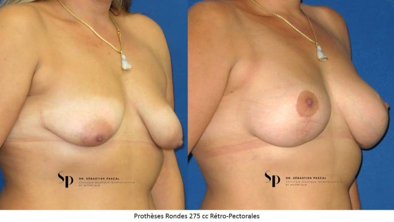 Poitrine - Cure de ptose mammaire AVEC PROTHESES (2)