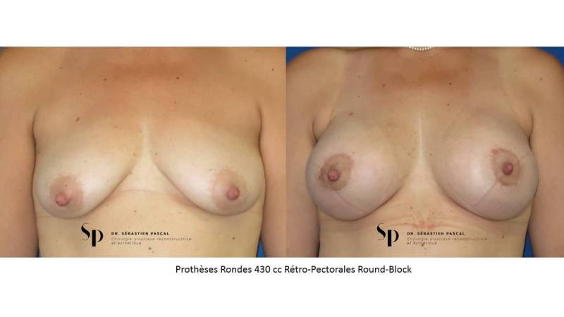 Poitrine - Cure de ptose mammaire AVEC PROTHESES (2)
