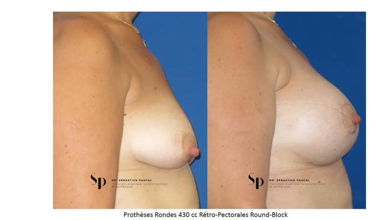 Poitrine - Cure de ptose mammaire SANS PROTHESES