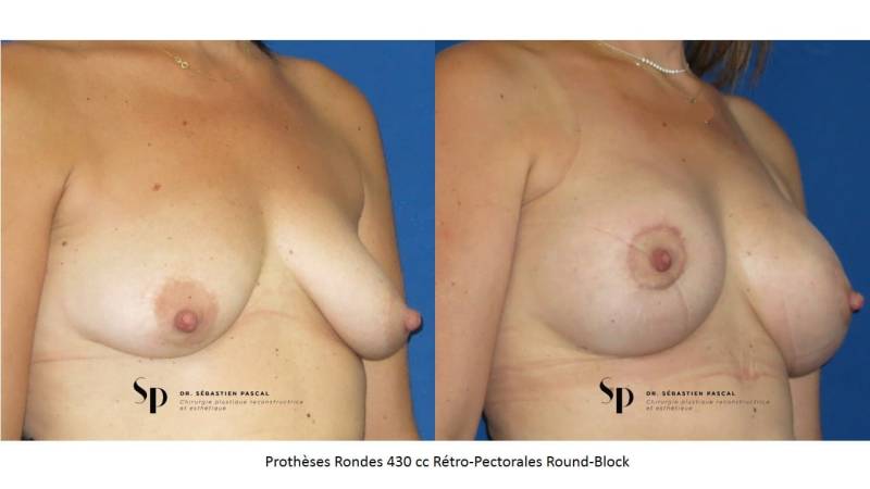 Poitrine - Cure de ptose mammaire SANS PROTHESES