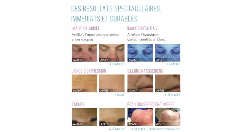 Traitement esthétique HYDRAFACIAL