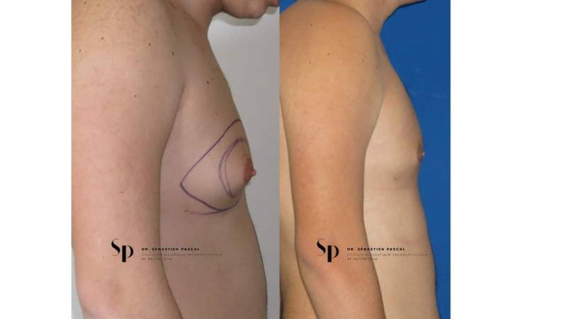 Homme - Gynécomastie