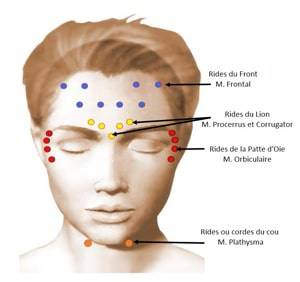 INJECTION DE TOXINE BOTULIQUE Marseille, La Ciotat : Lissage des rides et prévention du Vieillissement