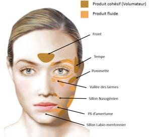 INJECTION D'ACIDE HYALURONIQUE par un chirurgien esthétique à Marseille