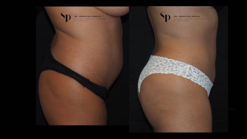 Silhouette - Lipoaspiration ou liposuccion
