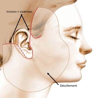 Lifting cervico facial à Marseille