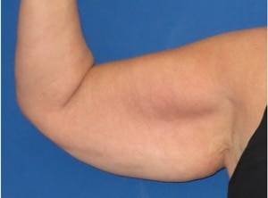 La chirurgie de l’homme Lifting de Bras ou Dermolipectomie Brachiale