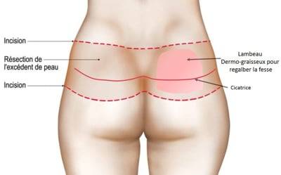 Chirurgie des fesses : Lifting et Lipofilling