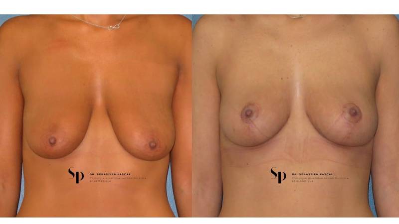 Poitrine - Cure de ptose mammaire SANS PROTHESES