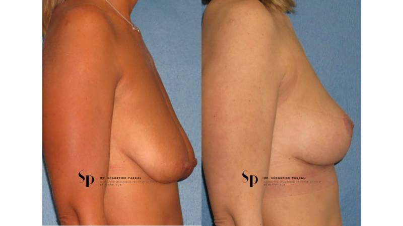 Poitrine - Cure de ptose mammaire SANS PROTHESES