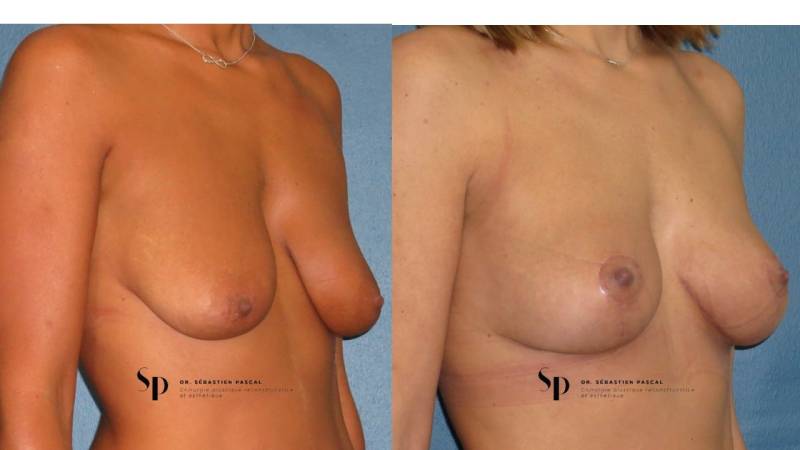 Poitrine - Cure de ptose mammaire SANS PROTHESES