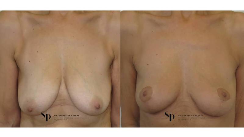 Poitrine - Cure de ptose mammaire SANS PROTHESES