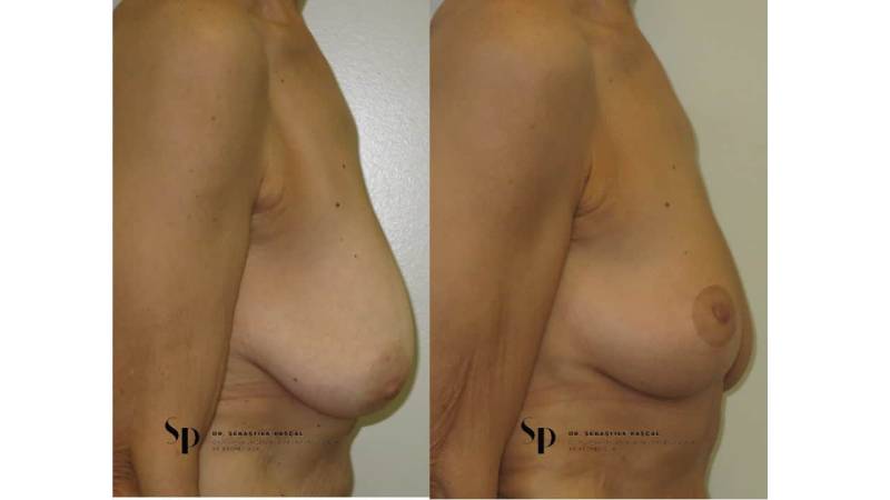 Poitrine - Cure de ptose mammaire SANS PROTHESES