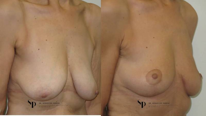 Poitrine - Cure de ptose mammaire SANS PROTHESES