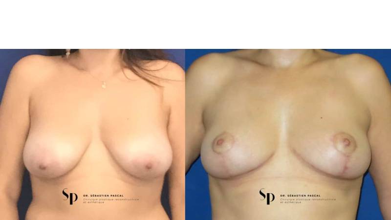 Poitrine - Cure de ptose mammaire SANS PROTHESES