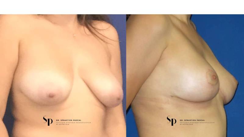 Poitrine - Cure de ptose mammaire SANS PROTHESES