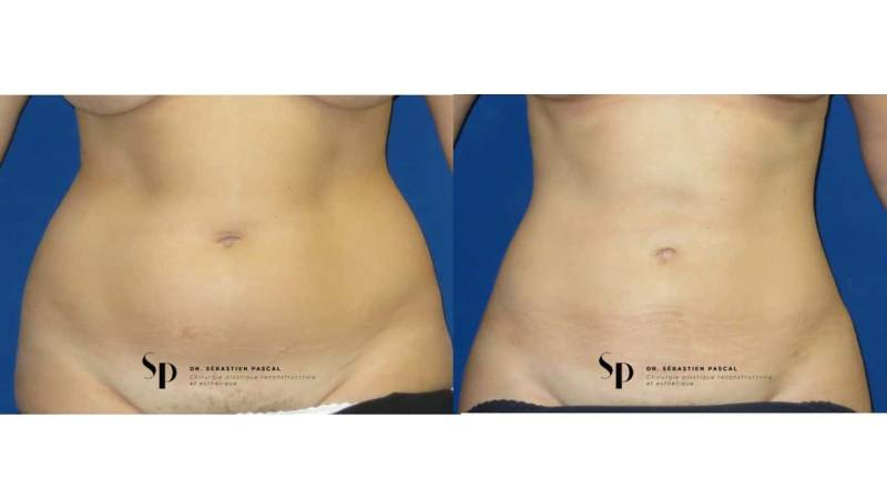 Silhouette - Lipoaspiration ou liposuccion