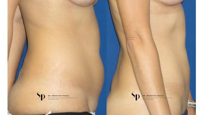 Lipoaspiration ou Liposuccion
