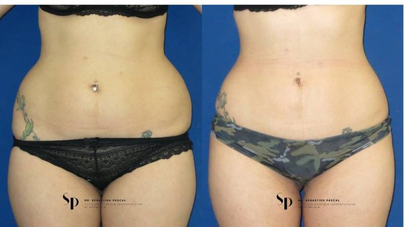 Silhouette - Lipoaspiration ou liposuccion