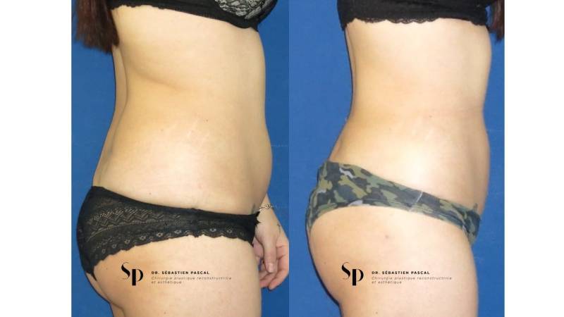 Silhouette - Lipoaspiration ou liposuccion