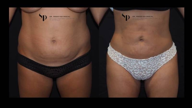 Silhouette - Lipoaspiration ou liposuccion