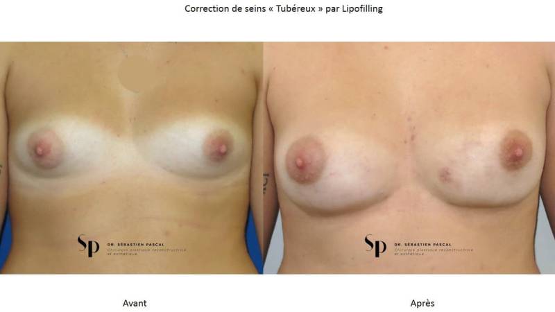 Poitrine – Malformations mammaire