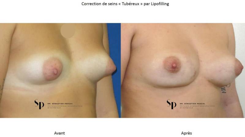 Poitrine – Malformations mammaire