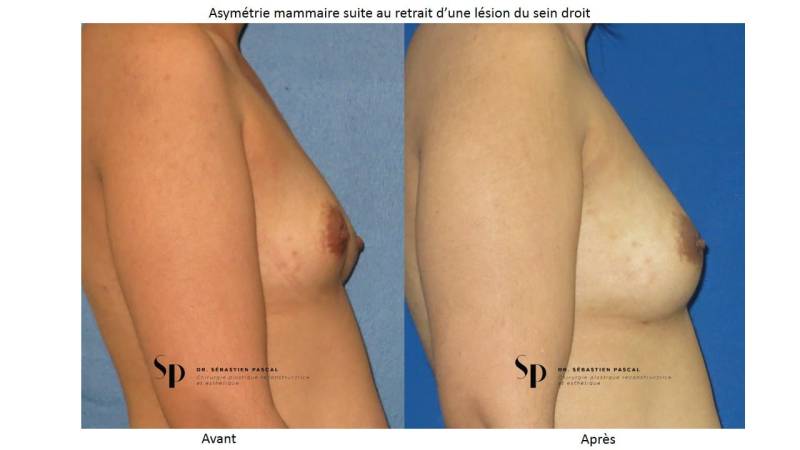 Malformations Mammaires