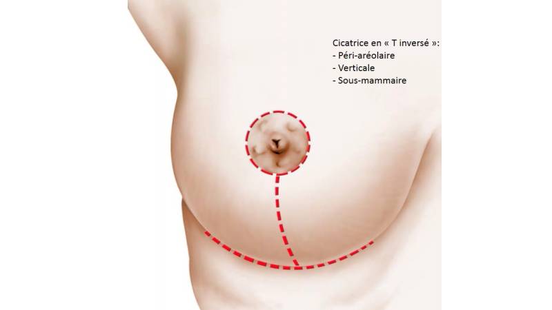 Réduction Mammaire et Hypertrophie Mammaire (HTM)