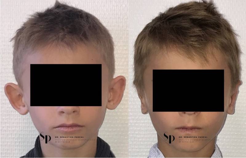 Otoplastie ou chirurgie des oreilles décollées