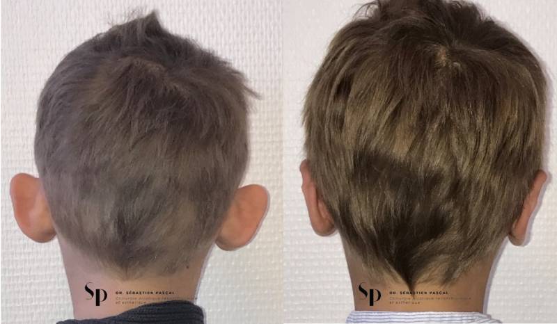 Visage - Chirurgie des Oreilles Décollées