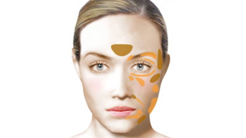 Lipostructure ou Réinjection de graisse (Lipofilling)