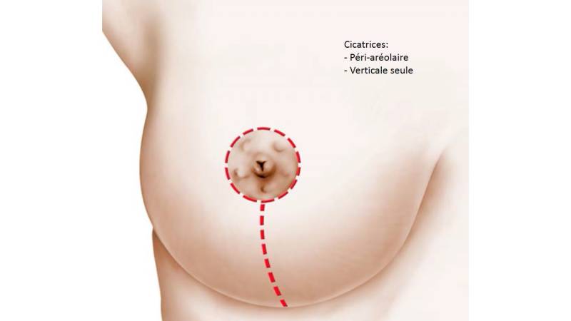 Cure de Ptose Mammaire et Prothèse (Mastopexie-Prothèse)