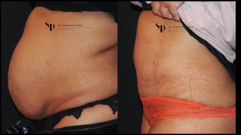 Silhouette - Abdominoplastie ou lifting du ventre