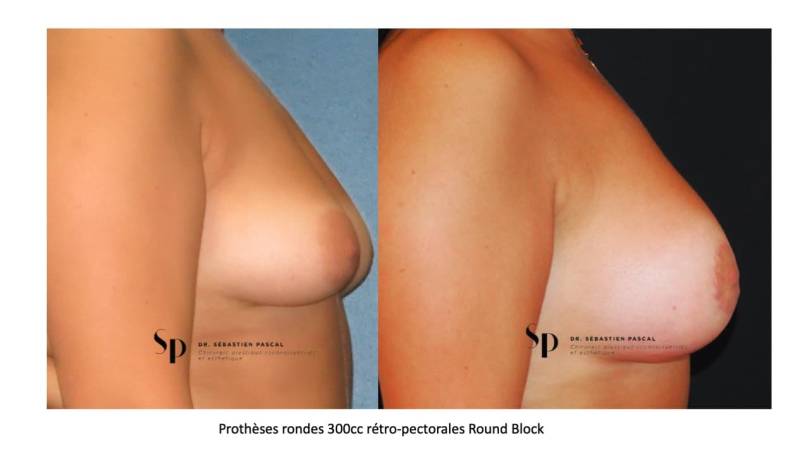 Poitrine – Augmentation mammaire par prothèse (3)
