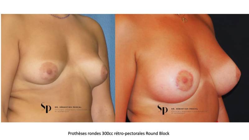 Poitrine – Augmentation mammaire par prothèse (3)