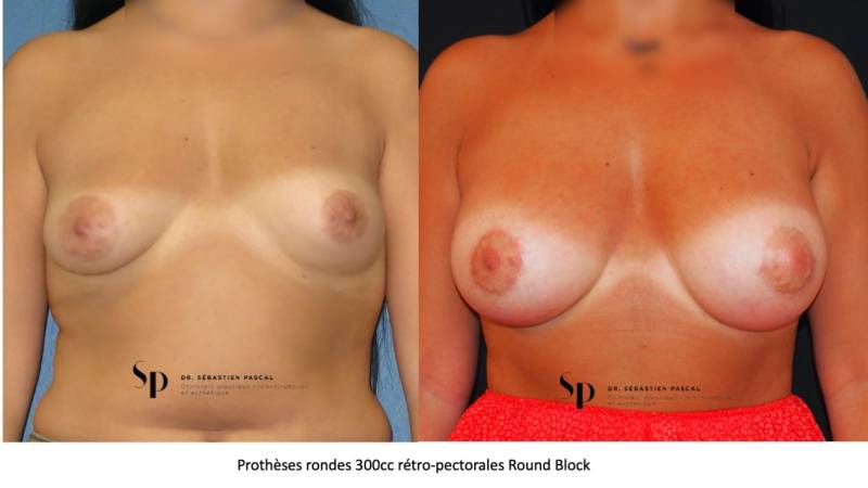 Poitrine – Augmentation mammaire par prothèse (3)