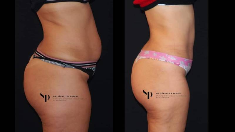 Silhouette - Abdominoplastie ou lifting du ventre