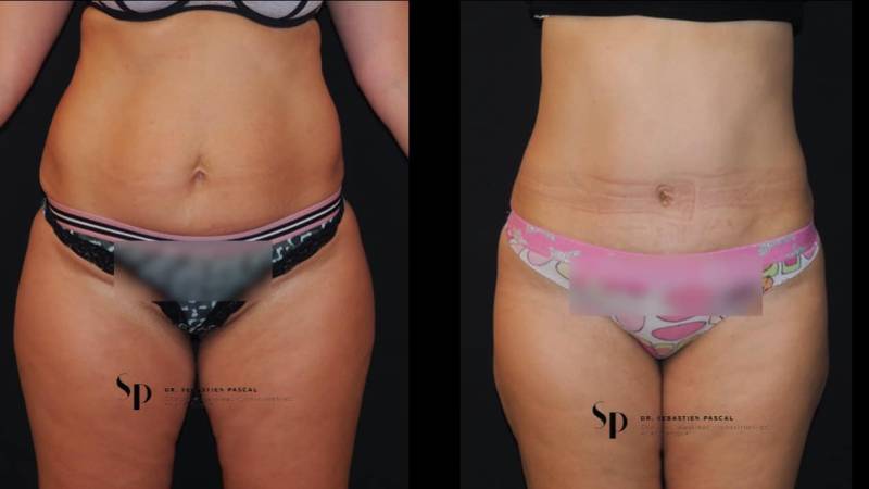 Silhouette - Abdominoplastie ou lifting du ventre