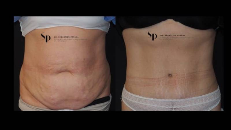 Silhouette - Abdominoplastie ou lifting du ventre