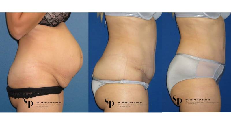 Silhouette - Abdominoplastie ou lifting du ventre