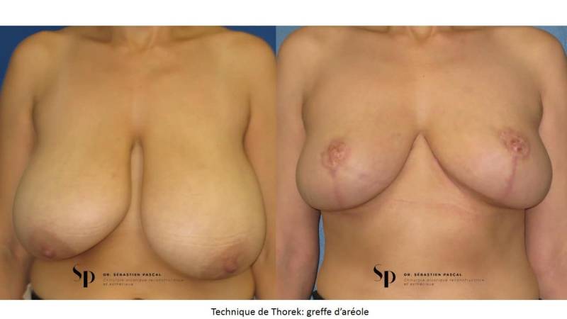 Poitrine – Réduction mammaire et hypertrophie mammaire